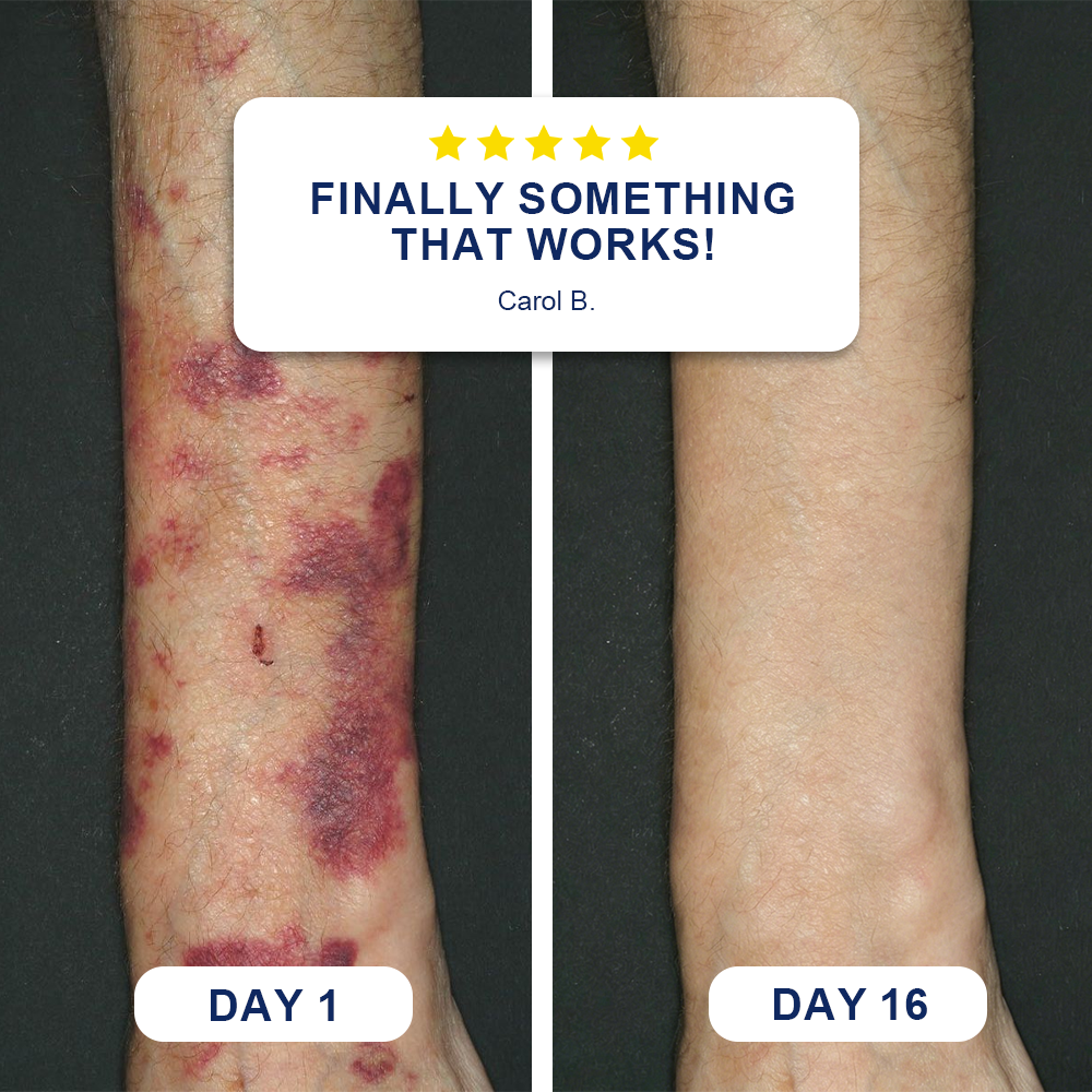 ✨Evolvion® Bruise Repair & Skin-Strengthening Cream 🍁