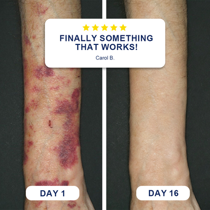✨Evolvion® Bruise Repair & Skin-Strengthening Cream 🍁
