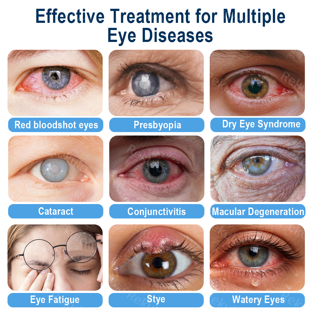 Rekulo® OptiMist Eye Spray✅For dry eyes, blurry vision, eye strain, presbyopia, and cataracts 🍁 up